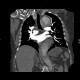 Aortic dissection, Stanford A, hemopericard: CT - Computed tomography